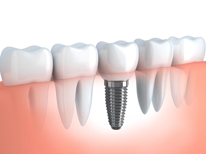 Dental Implants  Macomb, IL 